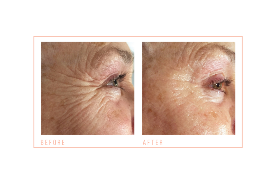 before and after Eye Revive at mojo beauty salon chorley