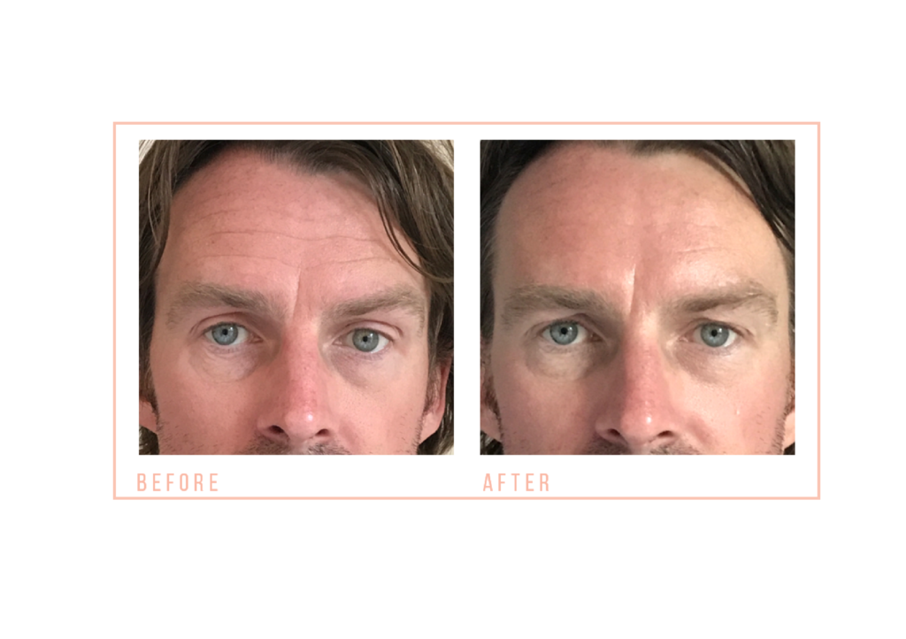 Male Non Surgical Facial Toning Before and After at mojo beauty salon chorley
