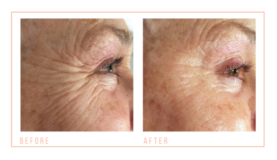 CACI TREATMENTS AT MOJO'S SALON, CHORLEY
